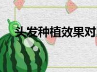 头发种植效果对比图片（头发种植效果）