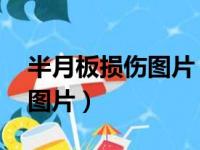 半月板损伤图片 图解核磁共振（半月板损伤图片）