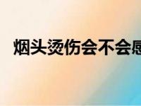 烟头烫伤会不会感染（烟头烫伤能当兵吗）